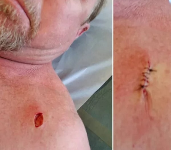 11. Пф, подумаешь какая-то меланома, это ведь даже не рак кожи...