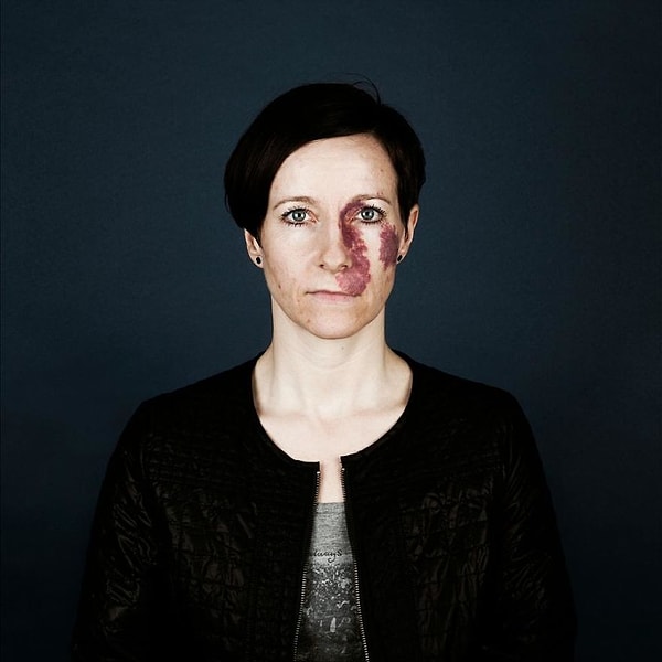 5. Второе название невуса фламеуса - "винное пятно" (это врожденное сосудистое образование на коже).