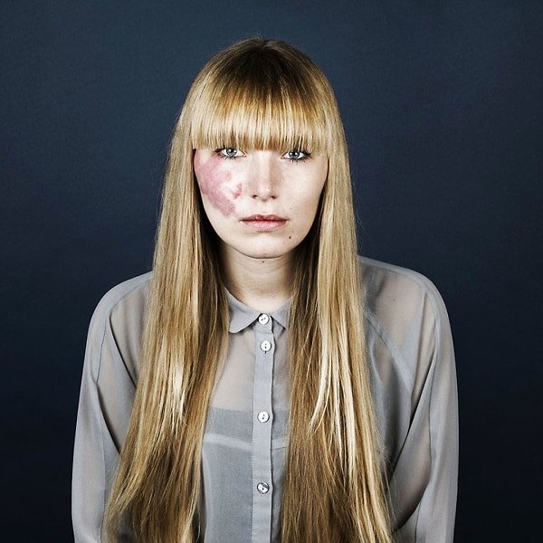 7. Людям кажется грубым таращиться на людей с винными пятнами на улице, но...