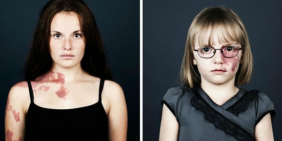 "Винные пятна" в фотопортретах: порок или природная отметина?