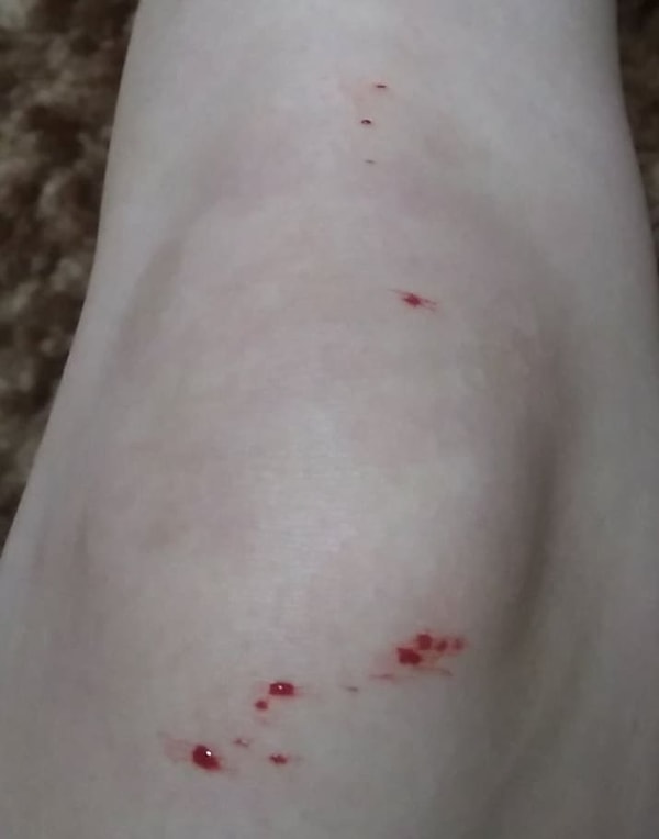 4. Бритьё ног может обернуться этим: