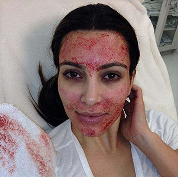 11. Kim Kardashian'ın sağlıkla parlayan cildinin sırrı ise biraz kanlı!
