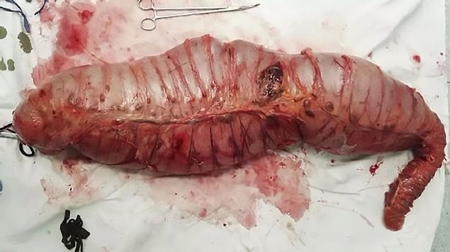 Çok uzun süre boyunca, hasta bağırsak hareketlerini kontrol edebilmek için kabızlık ilaçları ve laksatifler kullandı. Ancak şu an Dr. Yin Lu liderliğinde uzmanlardan oluşan bir ekip tarafından tedavi ediliyor.
