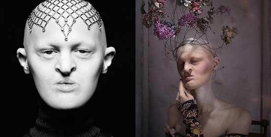 Модель с редким генетическим заболеванием стала мировой фэшн-иконой