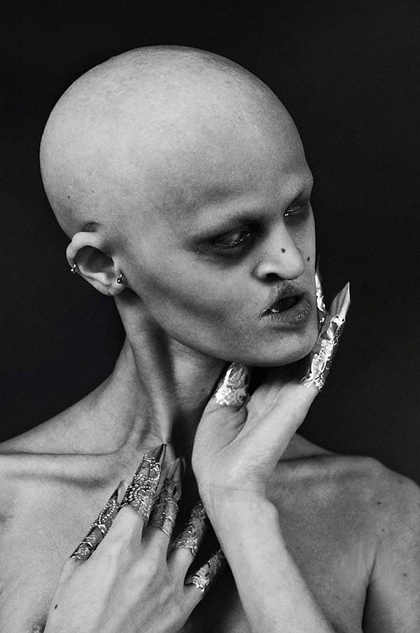 3. У Мелани всего 3 молочных зуба (постоянные зубы при таком заболевании не растут), также она лысая, без бровей и ресниц.