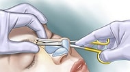 Olur da Diziniz Kırılırsa Eğer Doktorlar Kıkırdağı Başka Yerden Değil, Burnunuzdan Alacaklar!