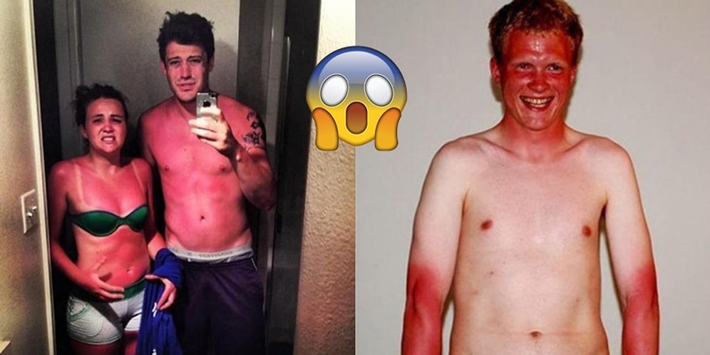 Yaz Geldi, Güneşlenme Sorunları Başladı: Yalnızca Çabucak Yananların Anlayacağı 23 Durum