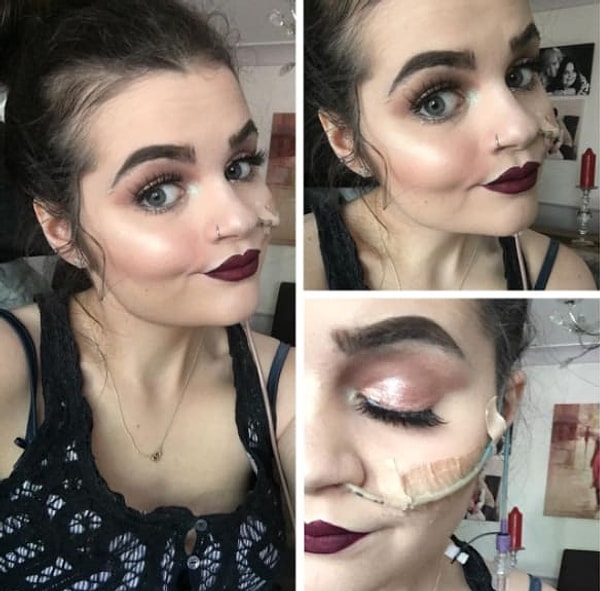 3. В Инстаграме Эмили уже почти 30 тыс. подписчиков, а использует она свою страничку в том числе и для того, чтобы показать другим, что даже сталкиваясь с определёнными трудностями, можно всё равно оставаться красивой.