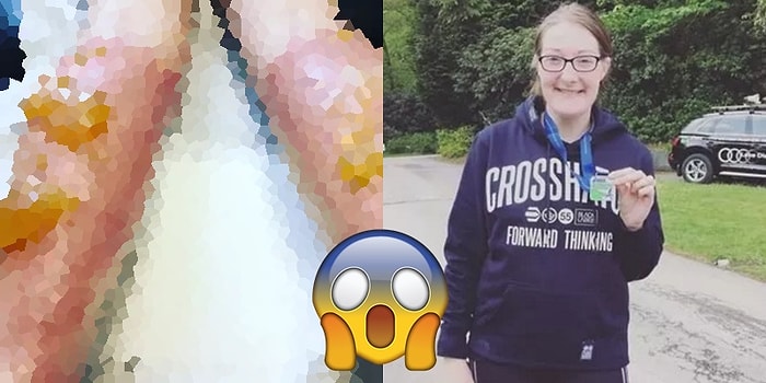 Güneş Kremi Kullanmadan Maraton Koşmaması Gerektiğini Acı Yoldan Öğrenen Sporcu