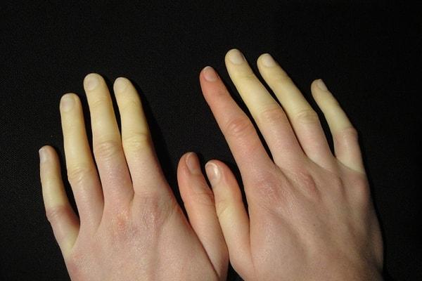 2. Parmaklarda renk değişimi