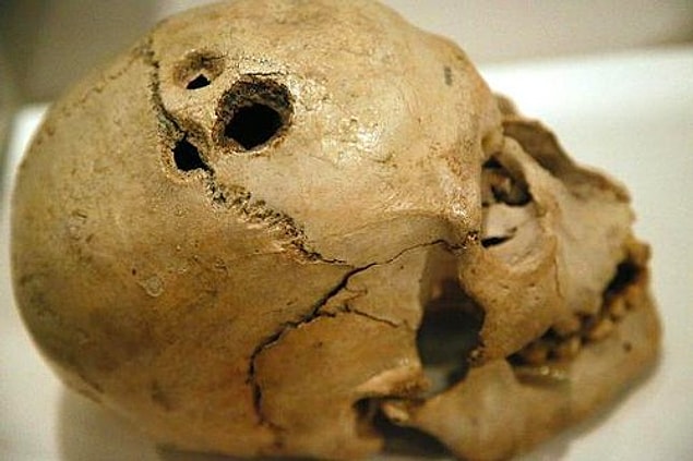 İlk çağlarda akıl hastalarını, kötü ruhların işgal ettiğine inanıldığı için kafatası deliniyor, yani trepanasyon uygulanıyordu.