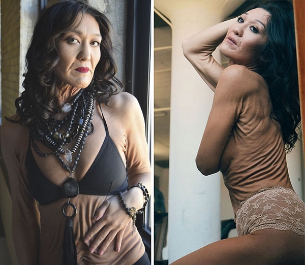 2. У нее синдром Элерса-Данлоса