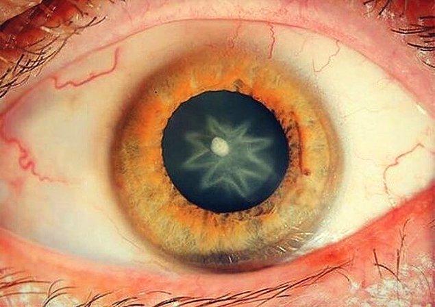 14. Yumruk yiyen bir adamın gözü hasar alınca yıldız şeklinde bir katarakt oluşmuş.