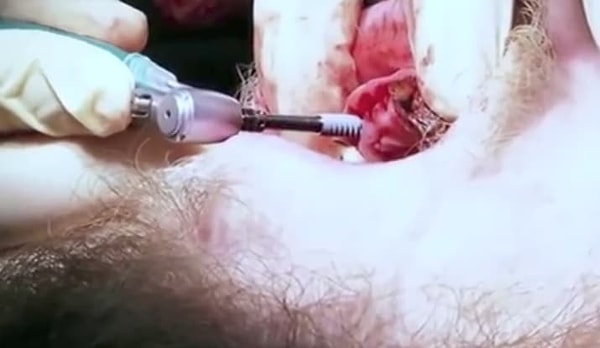 7. На их место были установлены импланты, самый большой достигал 18 мм в длину! НЕ НАЖИМАЙТЕ НА КАРТИНКУ, ЕСЛИ ВЫ БОИТЕСЬ СТОМАТОЛОГОВ!