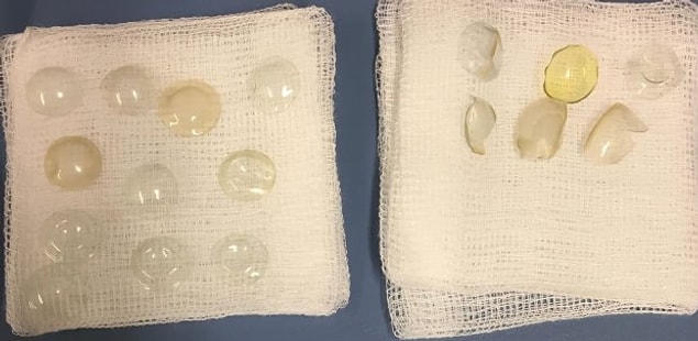 Optometrist Derneği sözcüsü Ceri Smith-Jaynes'e göre lenslerin kaybolması olası bir durum, ancak her zaman bir şekilde dışarı çıkıyorlar.