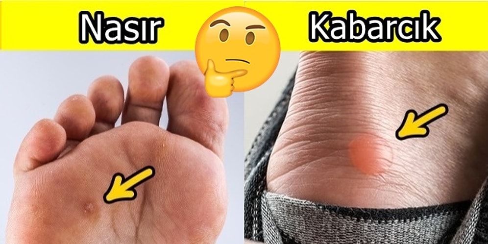 Ayaklara Özgürlük: Bir Gecede Nasırdan ve Kabarcıklardan Kurtulmanın En Sağlıklı Yolları