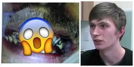 Neyse ki Diş Hekimleri Var! 20 Yıldır Dişlerine Fırça Sürmemiş Adamın İbretlik Hikayesi