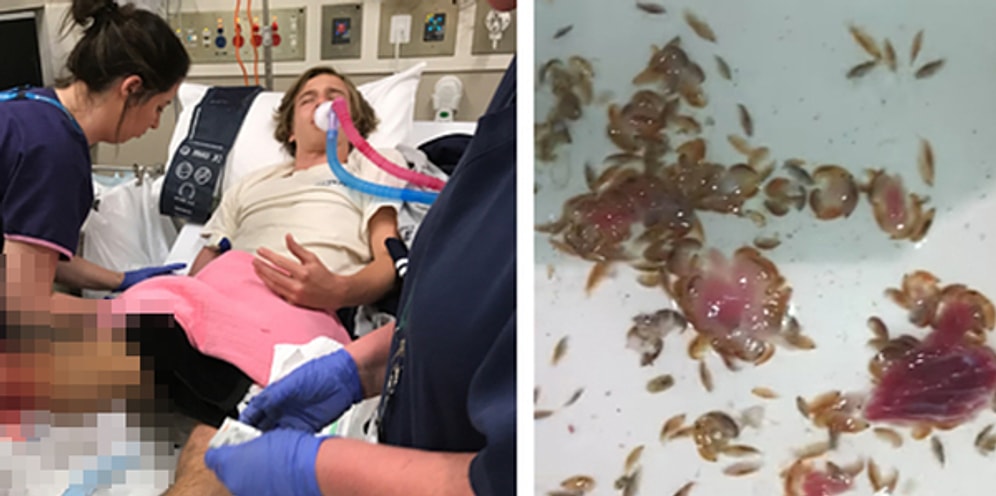 Avustralya'da Denize Giren Gencin Ayaklarını Nadir Görülen Bir Parazit Kemirmiş Olabilir!