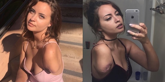 Девушка, потерявшая руку, стала звездой интернета благодаря своему чувству юмора