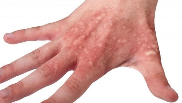 2. Контакт с каким растением может вызвать на коже раздражение, зуд и волдыри?