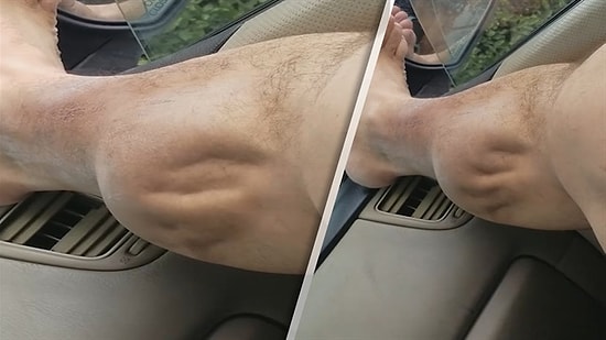 Baldır Kasına Giren Krampın Ürkütücü Görüntüsü