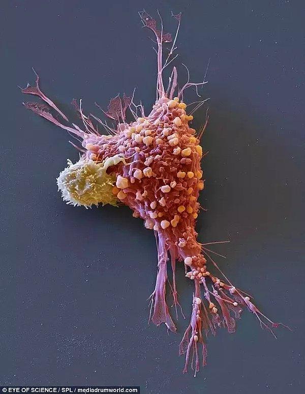 22. Göğüs kanseri hücresi.