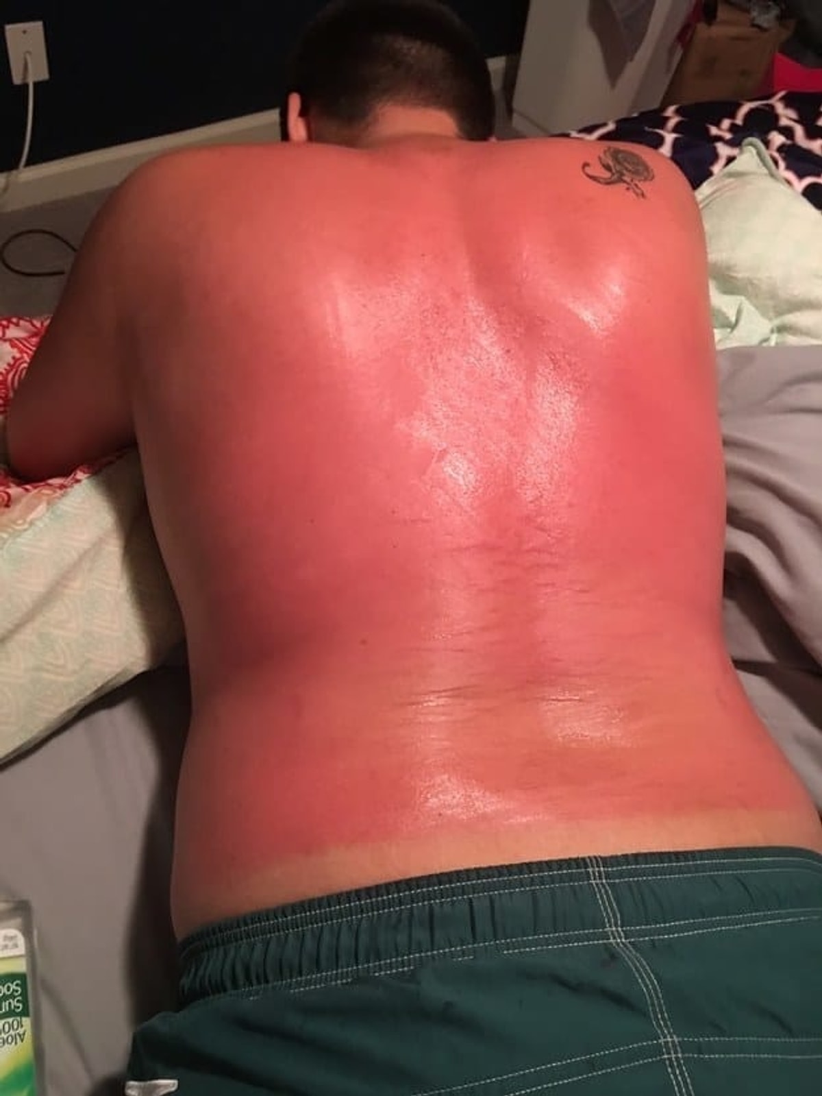 Что делать когда загорел. Что делать когда загорел. Что делать когда загорел. Лучшее время для загара. Обгоревшая на солнце кожа.