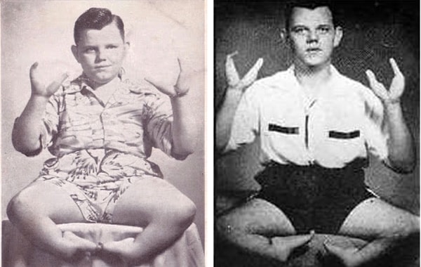 20. Грейди Стайлз - "Человек-рак"