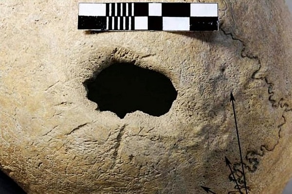 8. Трепанация черепа 3000 лет назад