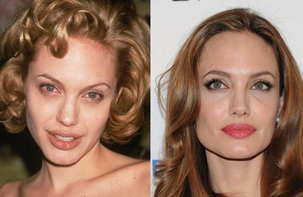 Burun Estetiği Düşünenlere 17 Maddelik Eşsiz Bir Rehber