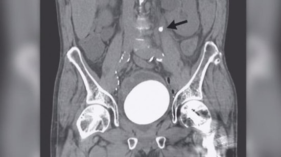 'Üşüttüm' Deyip Geçmeyin! 64 Yaşındaki Adamdan Deve Kuşu Yumurtası Büyüklüğünde Taş Çıktı!