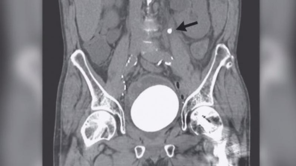 'Üşüttüm' Deyip Geçmeyin! 64 Yaşındaki Adamdan Deve Kuşu Yumurtası Büyüklüğünde Taş Çıktı!