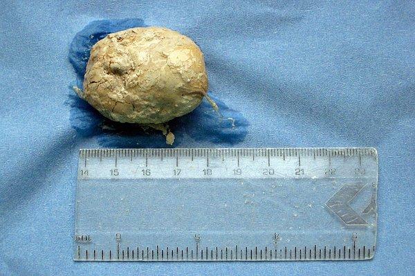 Yumurta şeklindeki taş ise ameliyatla alınıyor. Taş, 12,5 santimetre ve 770 gram ağırlığında.