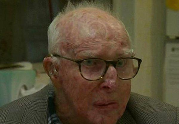 Avustralya, Sidney şehrinde yaşayan Bert Collins'in kanseri yenen en yaşlı insan olduğuna inanılıyor.
