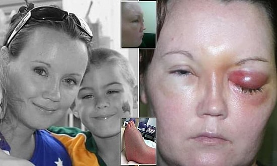 Avustralya'da Tedaviler Tükendi! Kontak Lensinden 'Göz Kemiren Parazitler' Kapan Kadın