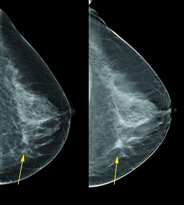 7. Aşırı kiloya sahip bireylerde menopoz sonrası meme kanseri olan kadınlarn hayatta kalma olasılıklarının daha düşük olduğu belirlenmiş.