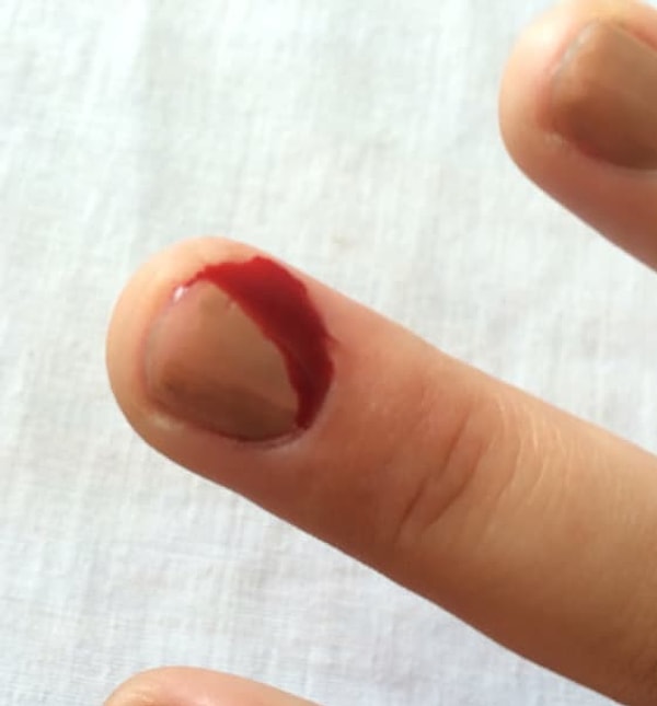 12. Удивляться внезапно обильному кровопролитию после отрывания невинного заусенца