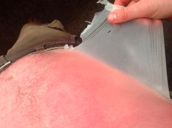 13. Пытаться снять с себя лоскут кожи побольше после обгорания на солнце...