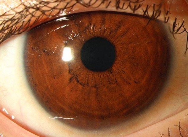 Tedaviden 6 hafta sonra hastanın iki gözündeki görme oranı da 20/800'ye kadar iyileşmişti. Alttaki fotoğrafta göründüğü üzere göz kuruluğu ve buna bağlı olarak beliren Bitot lekeleri de tamamen geçmişti.