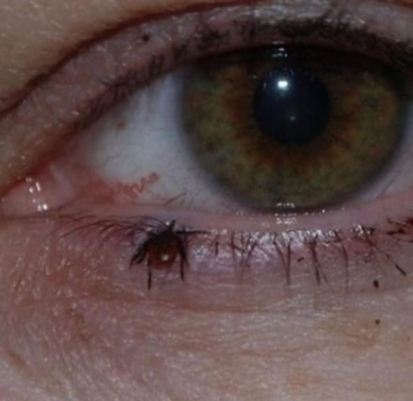 4. Ощущение, будто по веку передвигается что-то маленькое... и противное...