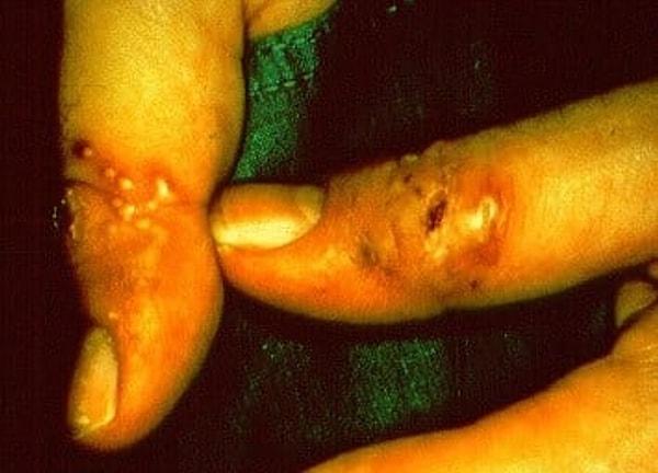 4. Virüs kapan bu tırnaklar ve parmaklar 😔
