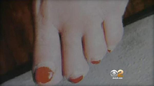 13. 'Makas' kullanılarak yapılan pedikür sonucu, ayak parmaklarından biri kaybeden kadın. 😢