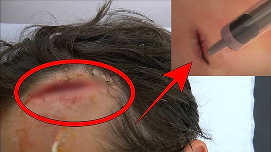 Bilim Kurgu Bir Kez Daha Gerçek Oluyor! Yarıkları Dikmek Yerine Artık Yapıştıracağız...