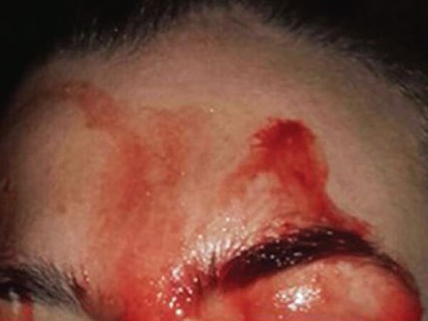 1. Женщина заметила, что последние три года у нее выступает кровь в районе подмышек и на ладонях, но при этом нет никаких видимых порезов.