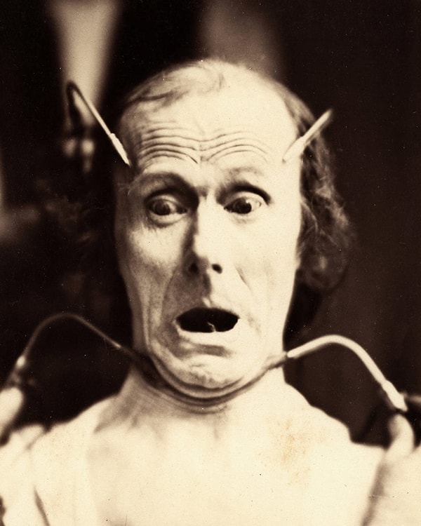 14. Пациент, подвергшийся экспериментальной электростимуляции в 1856 году