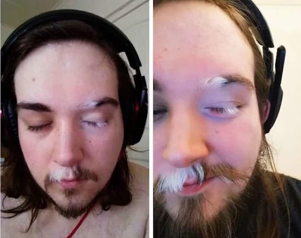 5. Так выглядит полиоз — частичная депигментация и поседение волос.