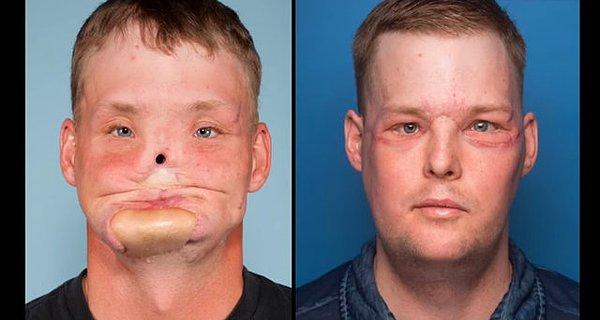 Yüzüne tüfekle ateş ederek intihar etmeye çalışan Andy Sandness'in yüzünün ameliyat öncesi ve sonrası görüntüsü.