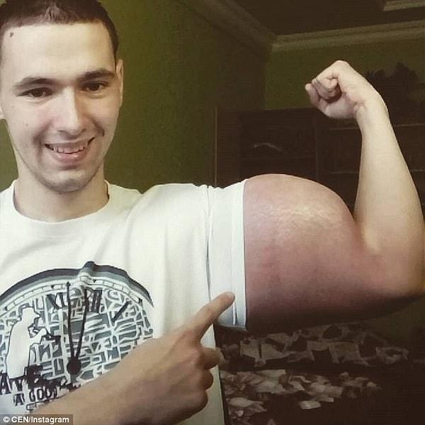 21 yaşındaki Kirill'in bu tuhaf görünümlü kasları spor yaparak değil, kas için madde enjekte ederek oluştu.