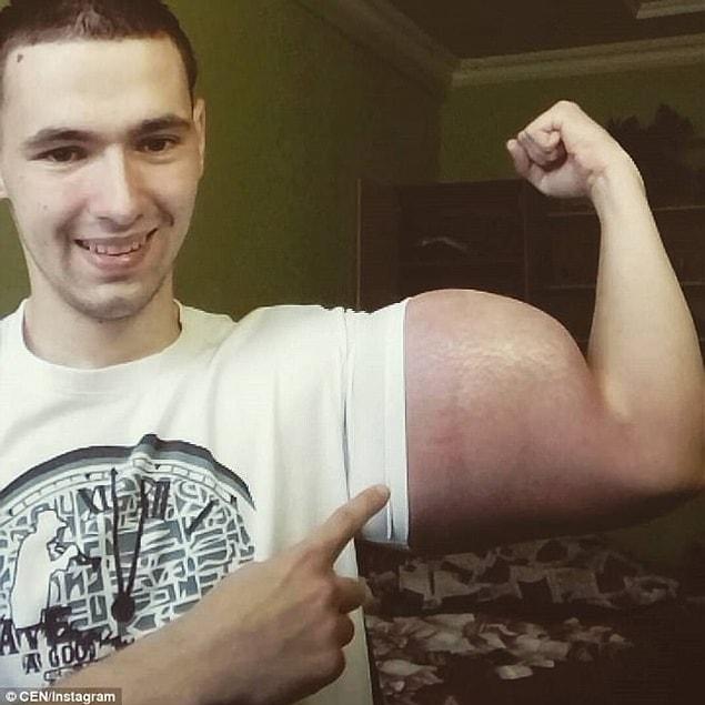 21 yaşındaki Kirill'in bu tuhaf görünümlü kasları spor yaparak değil, kas için madde enjekte ederek oluştu.
