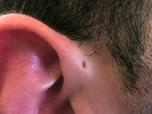 6. Preauricular Sinus